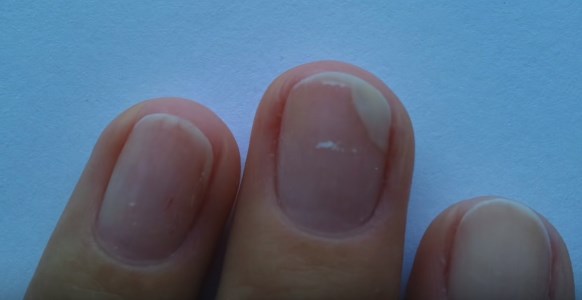 Болезни ногтя - самые частые жалобы