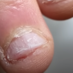 Грызунчик ногтей – невинная привычка или серьезное заболевание