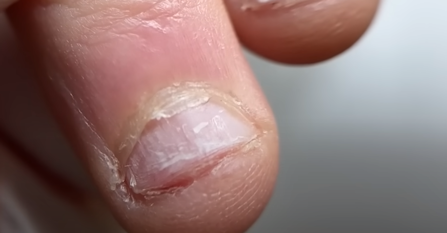 Грызунчик ногтей – невинная привычка или серьезное заболевание